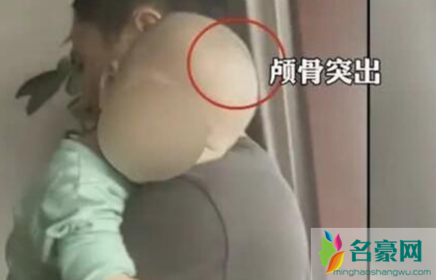 湖南郴州再现大头娃娃是怎么回事 2003大头娃娃奶粉事件