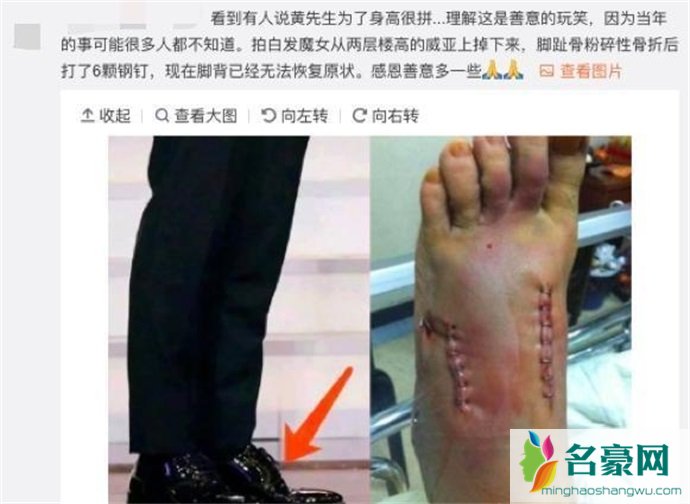 黄晓明受伤照