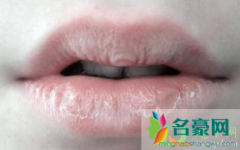 嘴唇干裂脱皮怎么办 嘴唇干裂脱皮抹唇膏一次要很多么