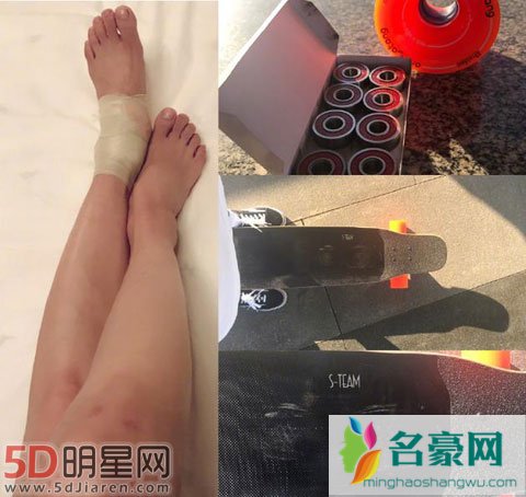 王珞丹晒滑板摔跤视频 谁料脚踝受伤绑绷带