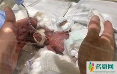 世界最小男孩诞生不足300克 重现现实版“拇指婴儿”