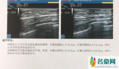 26岁小伙健身3个月乳房发育 小伙慌了崩溃大喊我还没有女朋友