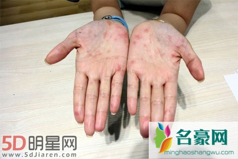 林心如患上玫瑰糠疹仍继续拍戏 身上已好不能拍手部特写