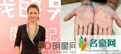 林心如患上玫瑰糠疹仍继续拍戏 身上已好不能拍手部特写