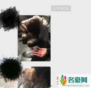 戚薇日本受伤 微博晒半张脸报平安